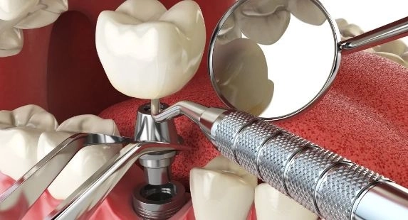 زراعة الأسنان باستخدام أحدث الأجهزة والتقنيات مع دكتور عبد الرحمن رؤوف