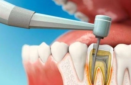 علاج جذور وعصب الأسنان مع دكتورة نورهان مصطفى علاج جذور وعصب الأسنان مع دكتورة نورهان مصطفى