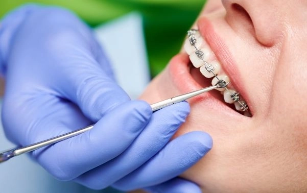 تقويم الأسنان للكبار والأطفال مع الدكتور اسلام حافظ تقويم الأسنان للكبار والأطفال مع الدكتور اسلام حافظ