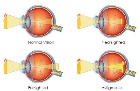 قصر وطول النظر والاستجماتيزم مع دكتور شهاب الدين امجد دويدار قصر وطول النظر والاستجماتيزم مع دكتور شهاب الدين امجد دويدار