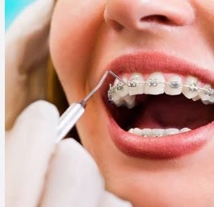 تقويم الأسنان بجميع أنواعه للكبار والأطفال مع مركز دينتال باى للاسنان 
