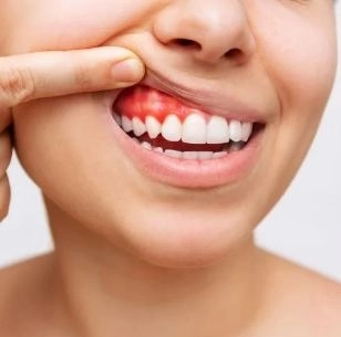 علاج التهاب اللثة واللثة الحساسة مع دكتورة رضوى جلال 