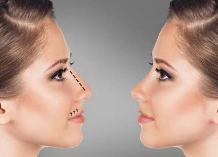 تجميل و نحت الأنف مع دكتور عبد الحميد الاشعل 