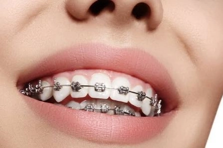 تقويم الأسنان مع دكتور احمد ماهر تقويم الأسنان مع دكتور احمد ماهر