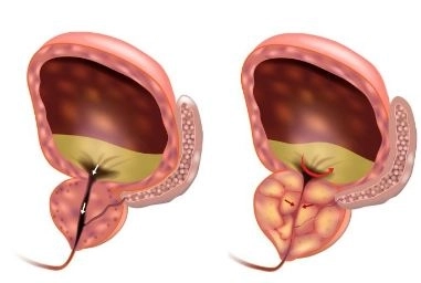 علاج تضخم البروستاتا جراحيًا أو بالمنظار مع دكتور عادل جرجس رسمى علاج تضخم البروستاتا جراحيًا أو بالمنظار مع دكتور عادل جرجس رسمى