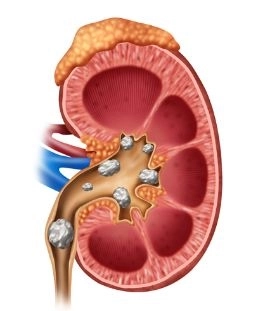 علاج حصوات الكلى والحالب والمثانة مع دكتور عادل جرجس رسمى علاج حصوات الكلى والحالب والمثانة مع دكتور عادل جرجس رسمى
