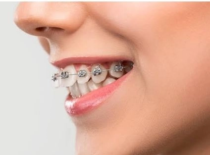 تقويم الاسنان لتصحيح مشاكل الاسنان مع عيادة اورا لطب و تجميل الاسنان تقويم الاسنان لتصحيح مشاكل الاسنان مع عيادة اورا لطب و تجميل الاسنان