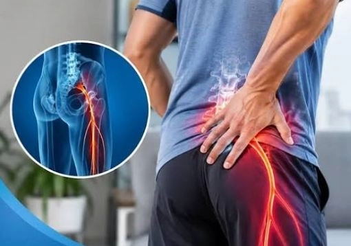 علاج عرق النسا مع مركز كيان للعلاج الطبيعى