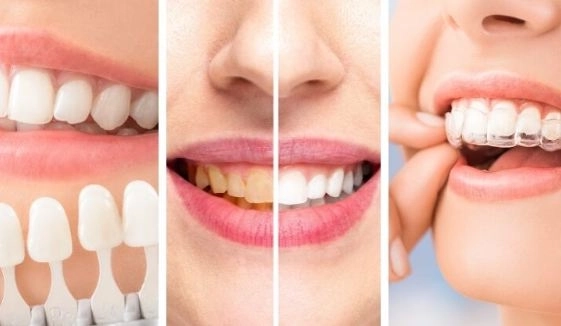 تجميل الأسنان وأهميته في تحسين الابتسامة مع دكتورة رشا الشبكى تجميل الأسنان وأهميته في تحسين الابتسامة مع دكتورة رشا الشبكى