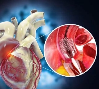 أمراض القلب والقسطرة التداخلية مع دكتور عمرو عصمان أمراض القلب والقسطرة التداخلية مع دكتور عمرو عصمان