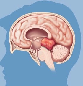 اورام المخ و قاع الجمجمة مع دكتور احمد الكشكى اورام المخ و قاع الجمجمة مع دكتور احمد الكشكى