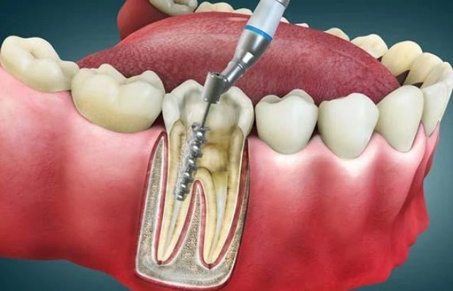 علاج جذور الأسنان وأهميته في الحفاظ على الأسنان مع دكتورة ايمان زكى علاج جذور الأسنان وأهميته في الحفاظ على الأسنان مع دكتورة ايمان زكى
