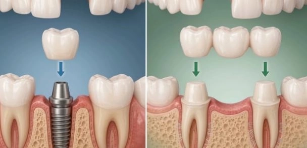 زراعة الأسنان وأهميتها لاستعادة شكلها مع دكتورة نرمين الرطبى زراعة الأسنان وأهميتها لاستعادة شكلها مع دكتورة نرمين الرطبى