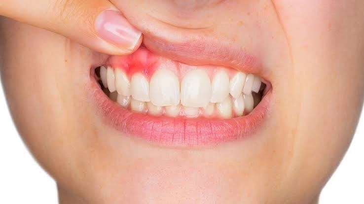 علاج أمراض اللثة وأهم طرق الحفاظ مع دكتور علاء احمد رميح علاج أمراض اللثة وأهم طرق الحفاظ مع دكتور علاء احمد رميح