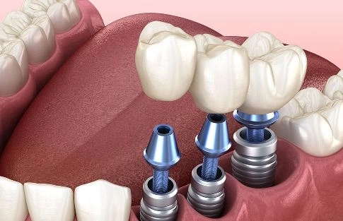 زراعة الأسنان باستخدام أحدث التقنيات مع دكتور حاتم عشماوى زراعة الأسنان باستخدام أحدث التقنيات مع دكتور حاتم عشماوى